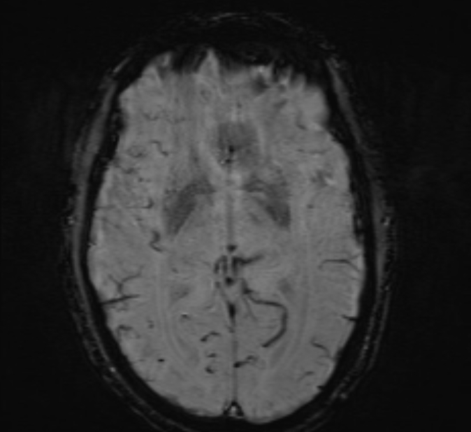 Cerebral venous thrombosis (Radiopaedia 71207-81504 Axial SWI 25).jpg