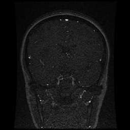 Cerebral venous thrombosis - ulcerative colitis (Radiopaedia 66049-75219 Coronal MRV 69).jpg