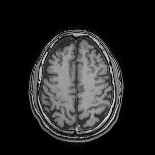 File:Cerebral venous thrombosis with secondary intracranial hypertension (Radiopaedia 89842-106957 Axial T1 129).jpg