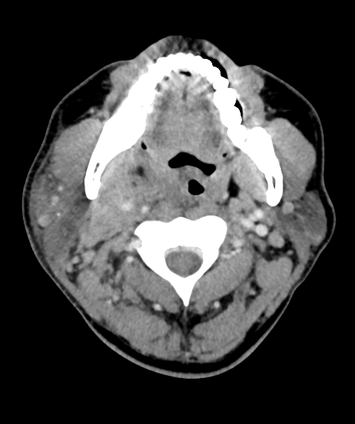 Cervical abscess (Radiopaedia 43725-47184 A 21).png