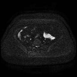 Cervical carcinoma (Radiopaedia 85405-101028 Axial DWI 60).jpg