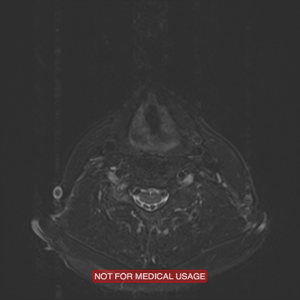 File:Cervical nerve schwannoma (Radiopaedia 27964-28221 C 37).jpg