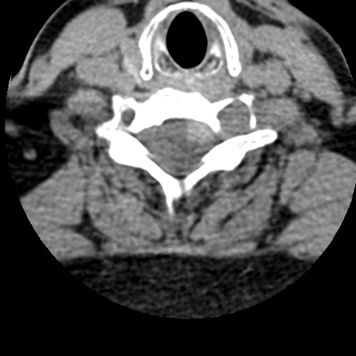 File:Cervical spinal neurofibroma in a patient with NF1 (Radiopaedia 58344-65464 Axial non-contrast 54).jpg
