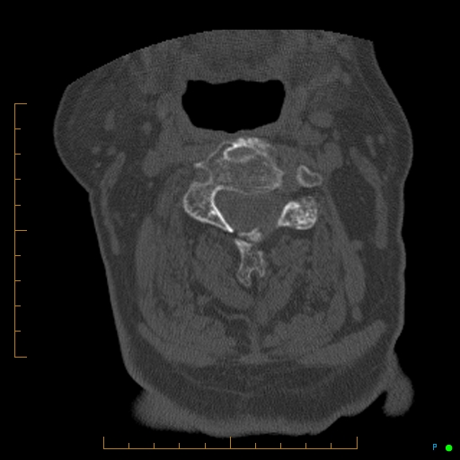 File:Cervical spine fracture - ankylosing spondylitis (Radiopaedia 76835-88706 Axial bone window 86).jpg