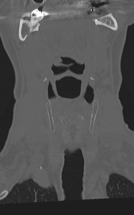 Cervical spine fractures with vertebral artery dissection (Radiopaedia 53296-59268 Coronal bone window 10).png