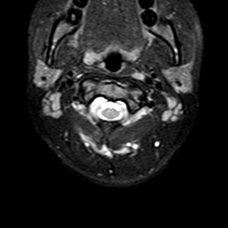 File:Cervical spine posterior ligamentous complex rupture (Radiopaedia 63486-72103 Axial T2 20).jpg
