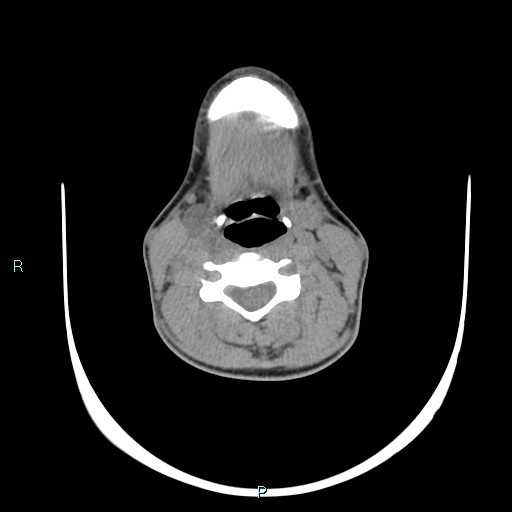 File:Cervical thymic cyst (Radiopaedia 88632-105335 Axial non-contrast 64).jpg