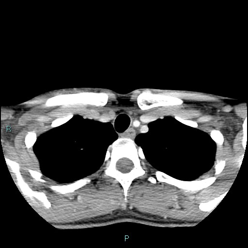 File:Cervical thymic cyst (Radiopaedia 88632-105335 C 22).jpg