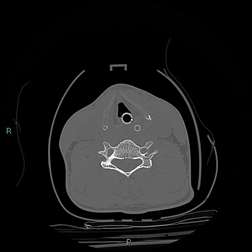 File:Cervical vertebral burst fracture (Radiopaedia 37420-39258 Axial bone window 6).jpg