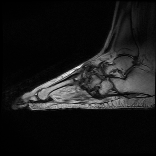 File:Charcot arthropathy (Radiopaedia 55056-61422 Sagittal T1 in-phase 11).jpg