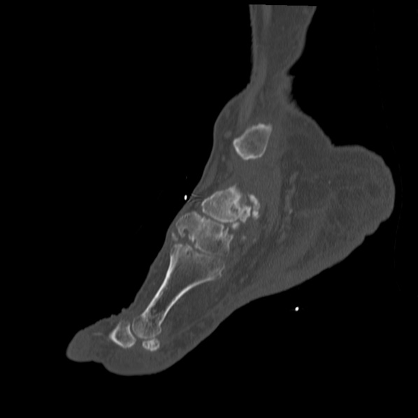Charcot joint (Radiopaedia 36629-38194 Sagittal bone window 65).jpg
