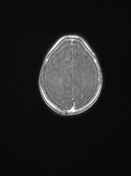 Chiari III malformation with occipital encephalocele (Radiopaedia 79446-92559 Axial T1 C+ mpr 69).jpg