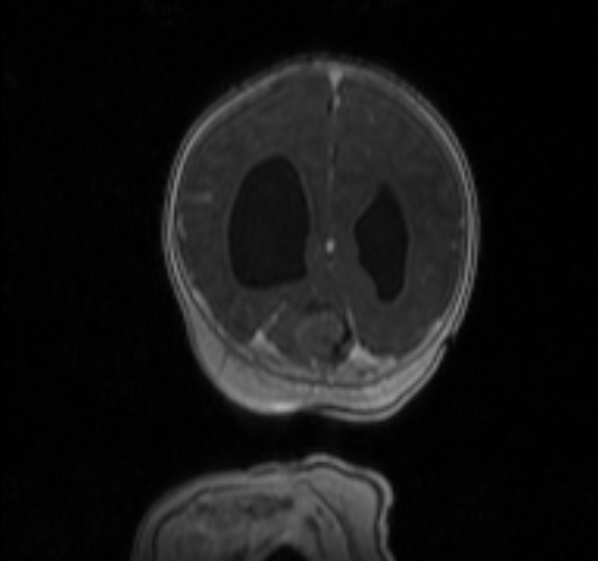 Chiari III malformation with occipital encephalocele (Radiopaedia 79446-92559 Coronal T1 C+ mpr 36).jpg