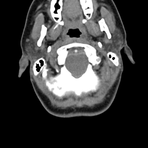 Chiari I malformation and obstructive hydrocephalus (Radiopaedia 41185-43981 D 32).png