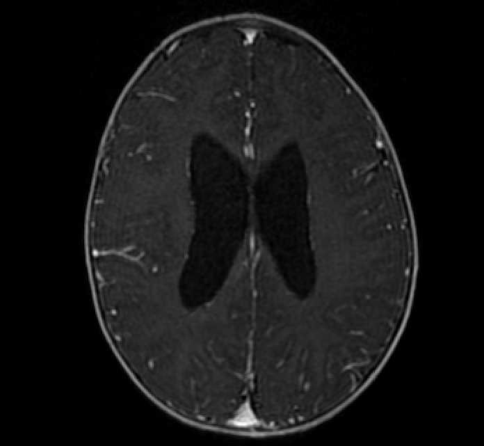 Chiasmatic-hypothalamic glioma (Radiopaedia 90079-107252 Axial T1 C+ 59).jpg