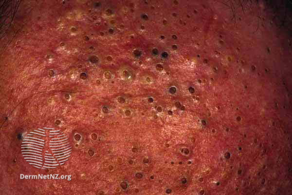 File:Chloracne blackheads (DermNet NZ acne-chloracne3).jpg