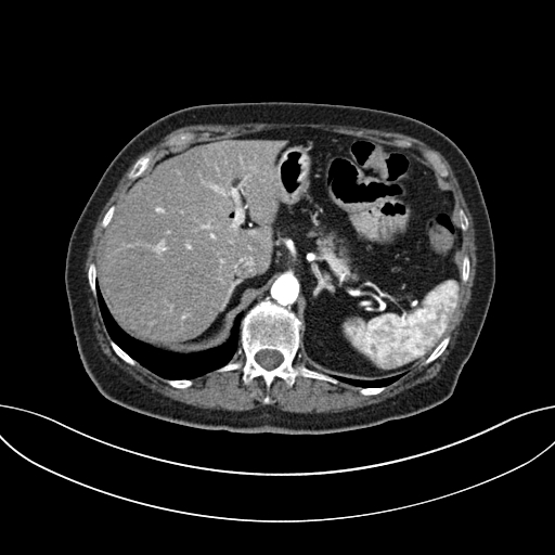 Cholecystoduodenal fistula due to calculous cholecystitis with gallstone migration (Radiopaedia 86875-103077 A 19).jpg