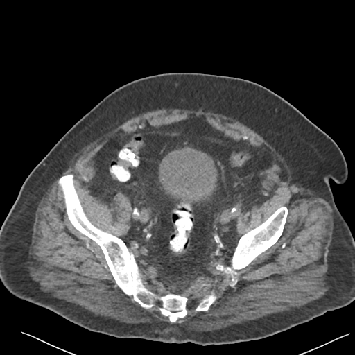File:Choledocholithiasis and gastric polyp (Radiopaedia 48856-53895 Axial non-contrast 72).png