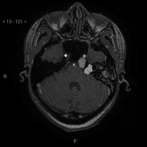 Cholesterol granuloma of the petrous apex (Radiopaedia 64358-73140 Axial TOF 3D 49).jpg