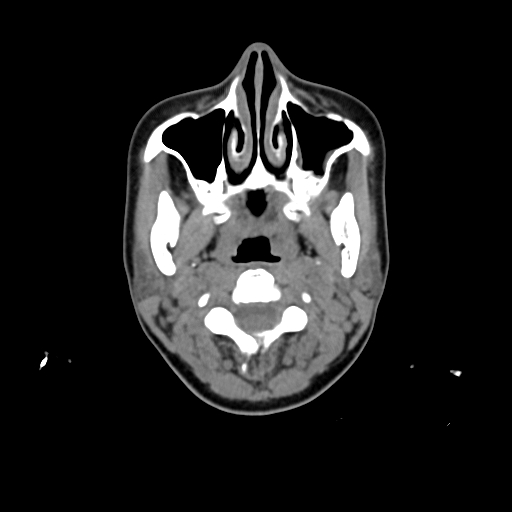 File:Chondroblastic osteosarcoma (Radiopaedia 67363-76741 Axial non-contrast 5).jpg
