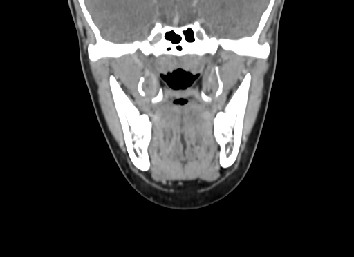 File:Chondroblastic osteosarcoma (Radiopaedia 67363-76741 D 54).jpg