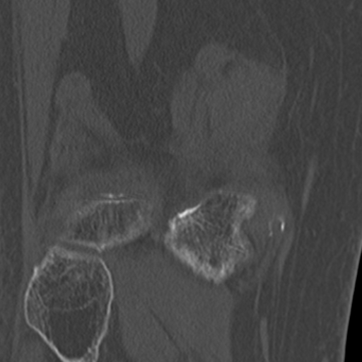 Chondrocalcinosis (Radiopaedia 16275-15955 Coronal bone window 45).jpg