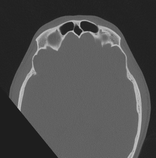 Chondrosarcoma (clivus) (Radiopaedia 46895-51425 Axial bone window 8).png