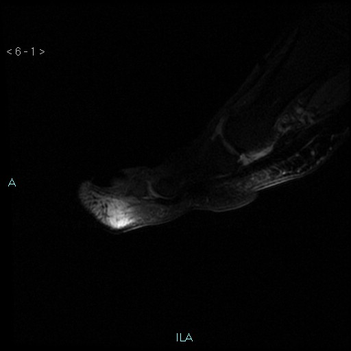 File:Chondrosarcoma - phalanx (Radiopaedia 69047-78813 Sagittal PD fat sat 1).jpg