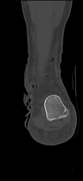 Chopart fracture (Radiopaedia 35347-36851 Coronal bone window 14).jpg