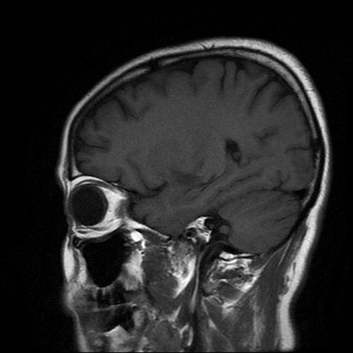 File:Chordoid glioma of third ventricle (Radiopaedia 91612-109340 Sagittal T1 7).jpg