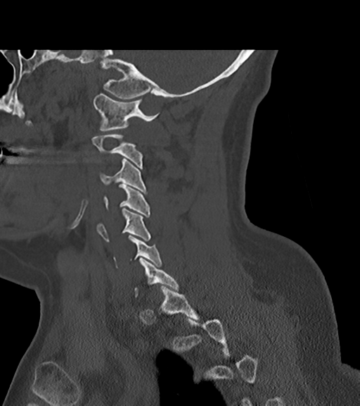 File:Chordoma (C4 vertebra) (Radiopaedia 47561-52188 Sagittal bone window 27).png