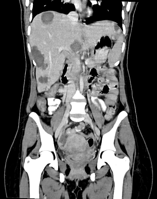 Choriocarcinoma liver metastases (Radiopaedia 74768-85766 B 54).jpg