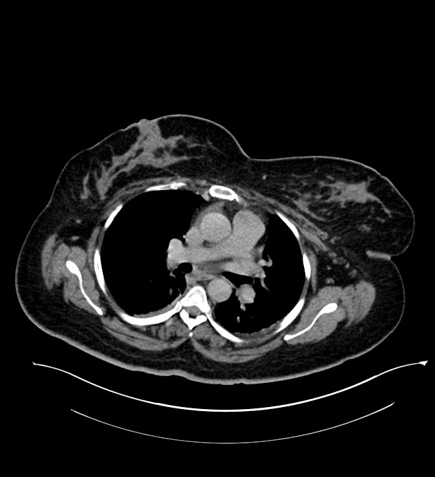 Chromophobe renal cell carcinoma (Radiopaedia 84239-99519 E 1).jpg