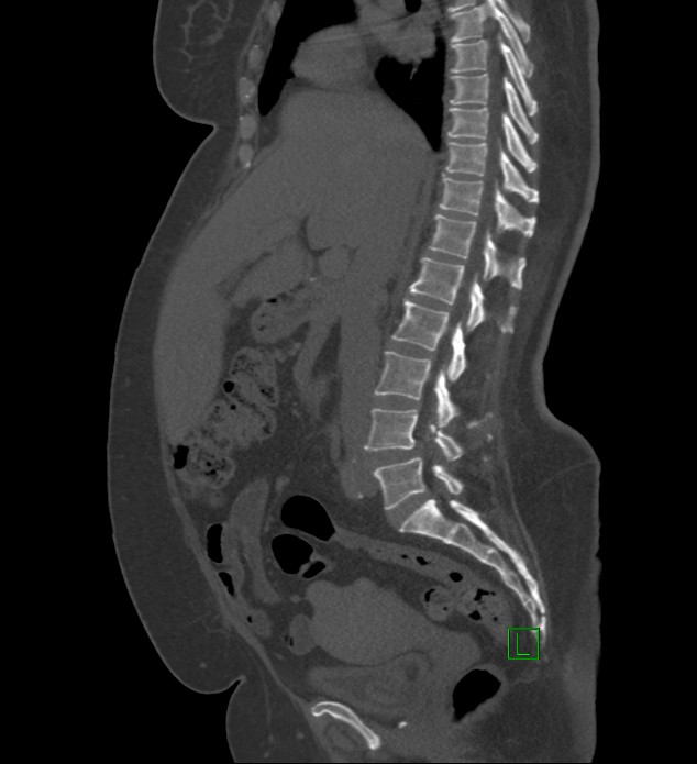 Chromophobe renal cell carcinoma (Radiopaedia 84239-99519 Sagittal bone window 61).jpg