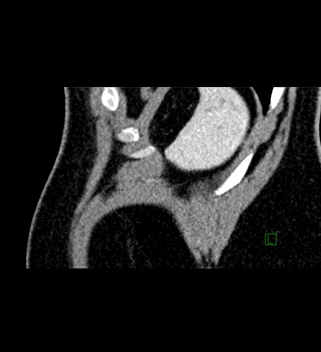 Chromophobe renal cell carcinoma (Radiopaedia 84286-99573 F 7).jpg