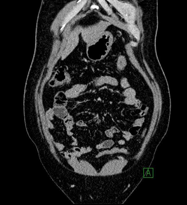 Chromophobe renal cell carcinoma (Radiopaedia 84286-99573 H 35).jpg