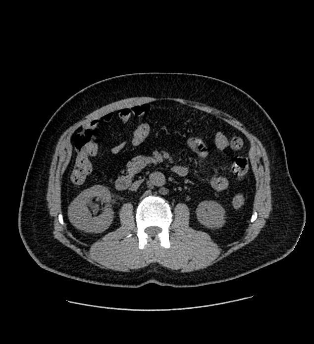Chromophobe renal cell carcinoma (Radiopaedia 84337-99693 Axial non-contrast 59).jpg