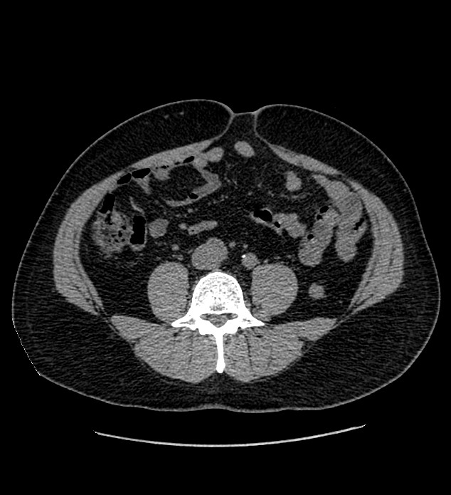 Chromophobe renal cell carcinoma (Radiopaedia 84337-99693 Axial non-contrast 94).jpg