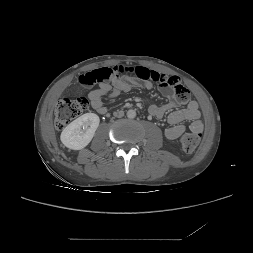File:Chronic IVC thrombosis and resultant IVC filter malposition (Radiopaedia 81158-94800 A 115).jpg