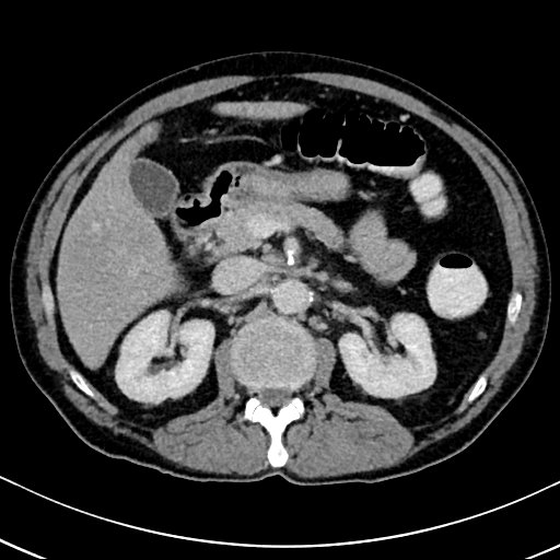 Chronic appendicitis complicated by appendicular abscess, pylephlebitis and liver abscess (Radiopaedia 54483-60700 B 59).jpg