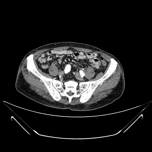 File:Chronic contained rupture of abdominal aortic aneurysm with extensive erosion of the vertebral bodies (Radiopaedia 55450-61901 A 56).jpg