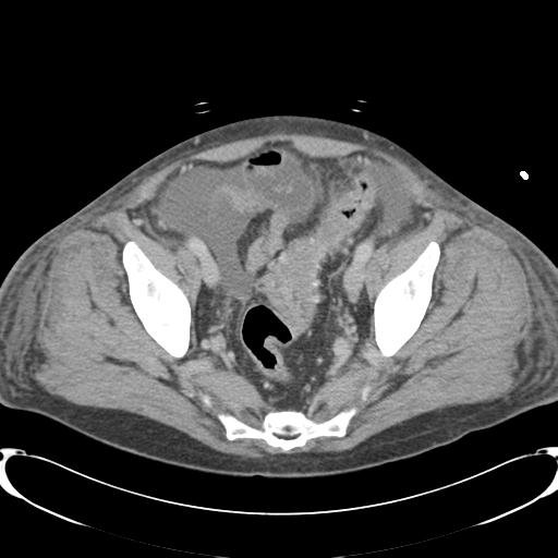 Chronic diverticulitis complicated by hepatic abscess and portal vein thrombosis (Radiopaedia 30301-30938 A 79).jpg
