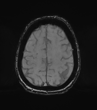 Chronic hypertensive encephalopathy (Radiopaedia 72844-83495 Axial SWI magnitude 67).png