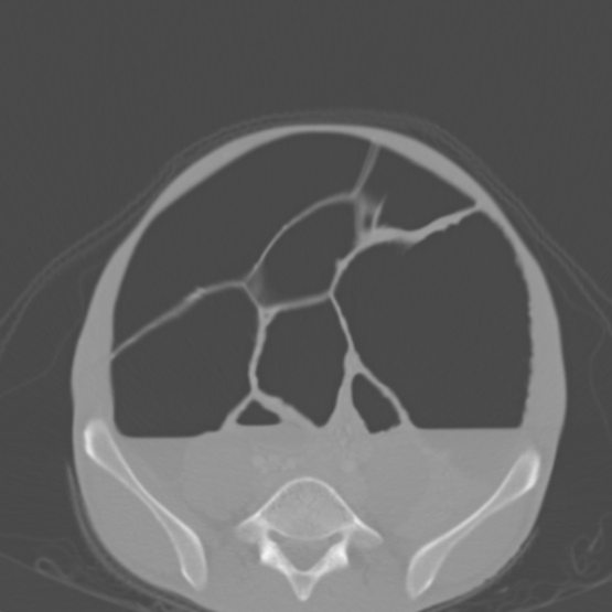 Chronic large bowel pseudo-obstruction (Radiopaedia 43181-46492 Axial bone window 122).jpg
