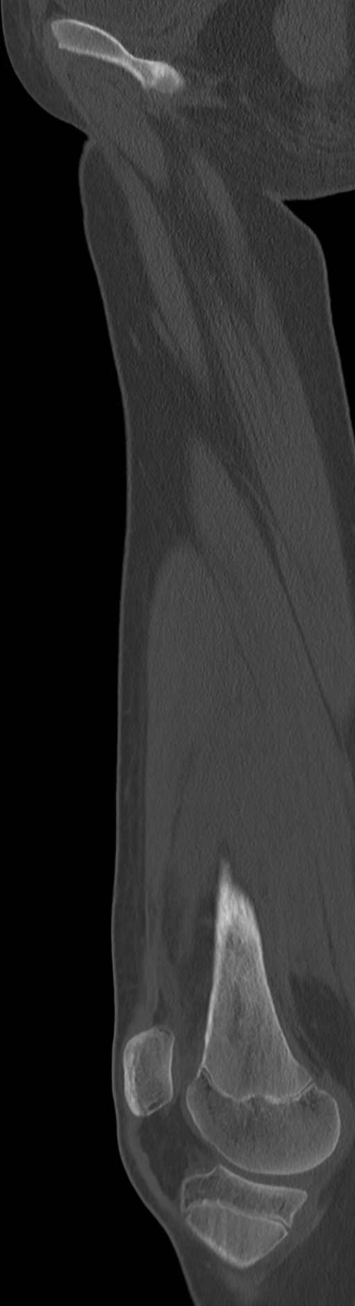 Chronic ostemyelitis of the femur with long sinus tract (Radiopaedia 74947-85982 Sagittal bone window 63).jpg
