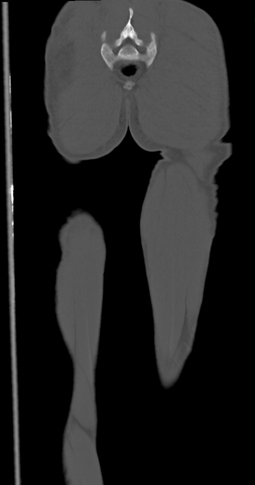 Chronic osteomyelitis (with sequestrum) (Radiopaedia 74813-85822 Coronal non-contrast 52).jpg