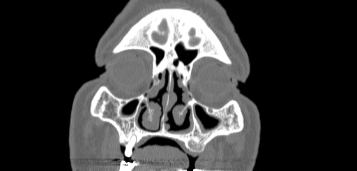 Chronic sphenoidal sinusitis (Radiopaedia 62030-70122 Coronal bone window 28).jpg