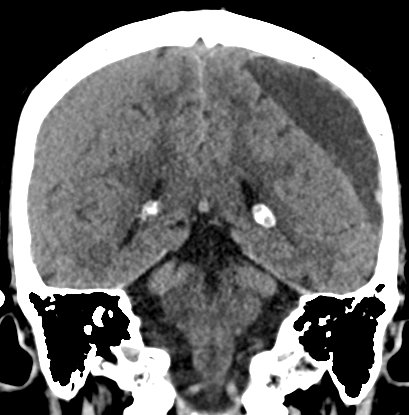 Chronic subdural hematomas (Radiopaedia 66577-75885 Coronal non-contrast 40).jpg
