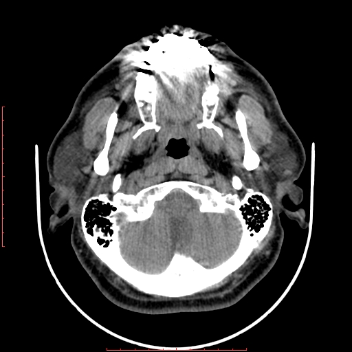 File:Chronic submandibular sialolithiasis (Radiopaedia 69817-79814 Axial non-contrast 38).jpg