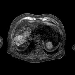 Cirrhosis and hepatocellular carcinoma in the setting of hemochromatosis (Radiopaedia 75394-86594 Axial T1 C+ fat sat 65).jpg